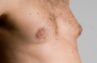 Minor breast tissue